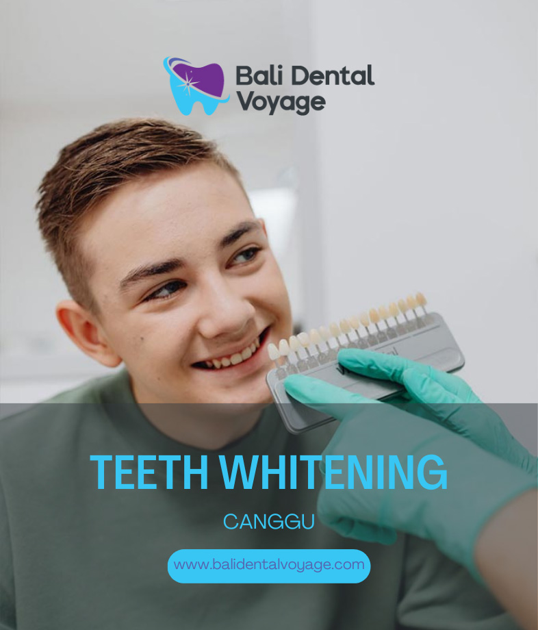 Teeth Whitening Canggu - Teeth Whitening Bali Canggu